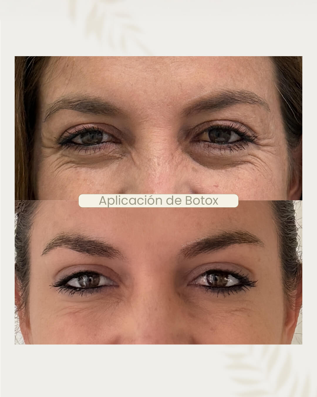 Toxina Botulínica-04